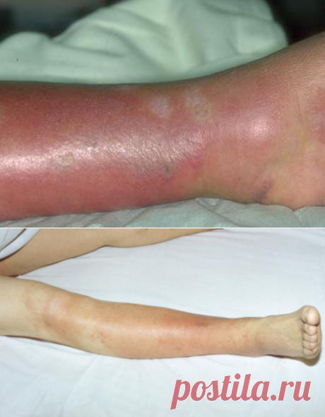 Рожистое воспаление ноги (рожа) – симптомы и лечение болезни, признаки на фото, как проявляет себя недуг на начальной стадии далее