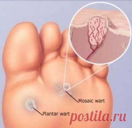 Действенный рецепт от бородавок