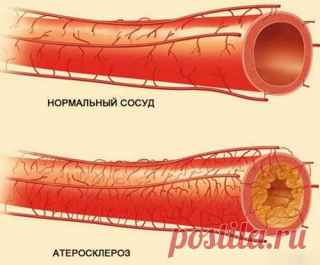 ЛИШЬ 50 МЛ В ДЕНЬ ЭТОГО МОЩНОГО НАПИТКА ОЧИЩАЮТ АРТЕРИИ И ПРЕДУПРЕЖДАЮТ СЕРДЕЧНЫЙ ПРИСТУП!