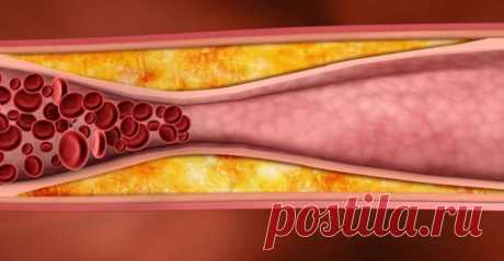 Как очистить сосуды от бляшек / Будьте здоровы