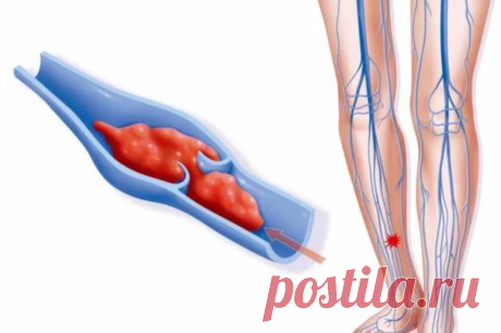 Легкое упражнение против тромбов в ногах. Помогает уже через 2-3 занятия | Семейный здравник | Яндекс Дзен