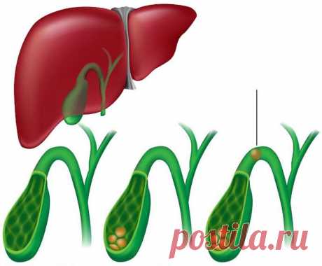 Избавление от камней и лечение желчного пузыря народными методами | Golbis