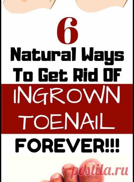 Treat Your Ingrown Toenail With These 6 Natural &amp; Homemade Remedies