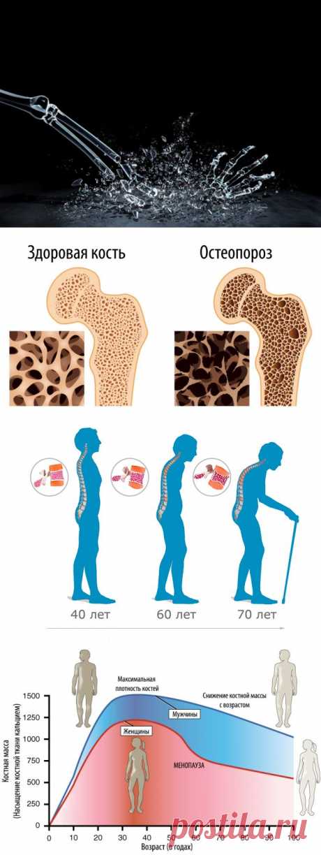 Что такое остеопороз и почему он возникает