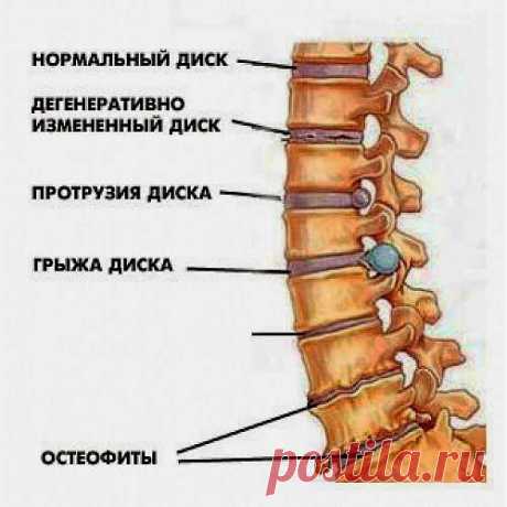 МЕЖПОЗВОНОЧНАЯ ГРЫЖА. ЛЕЧЕНИЕ БЕЗ ОПЕРАЦИИ..