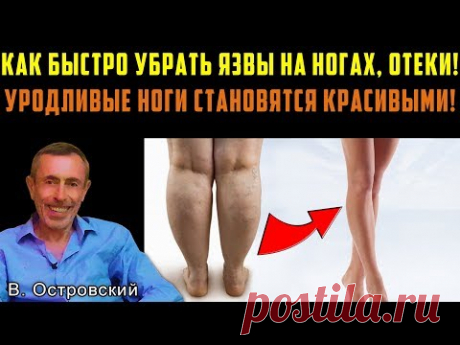 КАК БЫСТРО УБРАТЬ ЯЗВЫ НА НОГАХ, ОТЕКИ НОГ! УРОДЛИВЫЕ НОГИ СТАНУТ КРАСИВЫМИ! Варикоз, болезнь рейно.