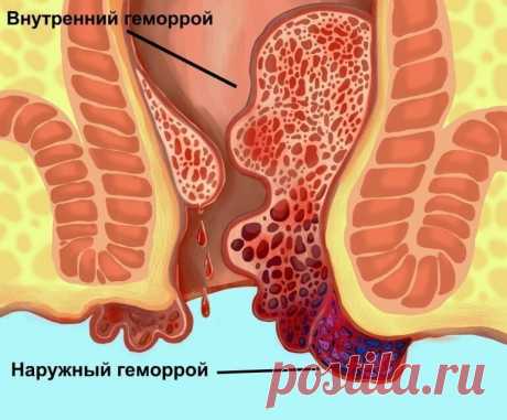 Симптомы и признаки геморроя / Будьте здоровы