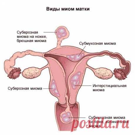 Миома матки: неизбежна ли операция? Симптомы и лечение народными средствами... | Познавательный сайт ,,1000 мелочей&quot;