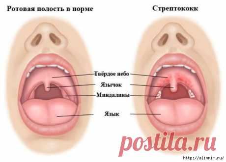 Полезная информация: СТРЕПТОКОКК ГОРЛА: 10 НАТУРАЛЬНЫХ СРЕДСТВ