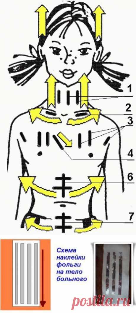 Лечение при помощи алюминиевой фольги | Правила здоровья и долголетия