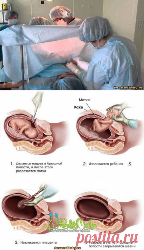 У кесарева сечения обнаружили негативные последствия для мам и детей :: форум общения родителей: forumroditeley.ru