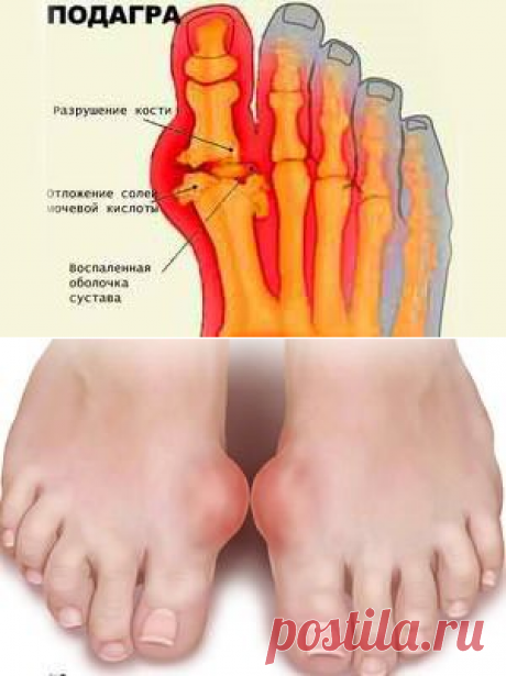 Подагра - причины, признаки, симптомы и лечение. Подагра на ногах у мужчин
