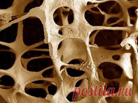 Остеопороз - чем он страшен.