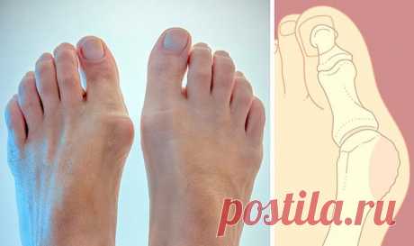 Как лечить шишку на большом пальце ноги
