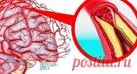 Рецепты для очищения сосудов головного мозга