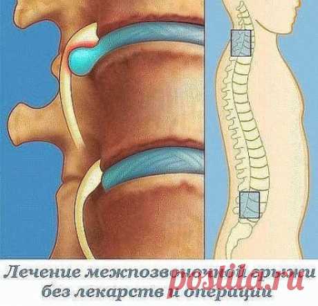 Лечение межпозвоночной грыжи без лекарств и операции: упражнения для спины от Шамиля Аляутдинова