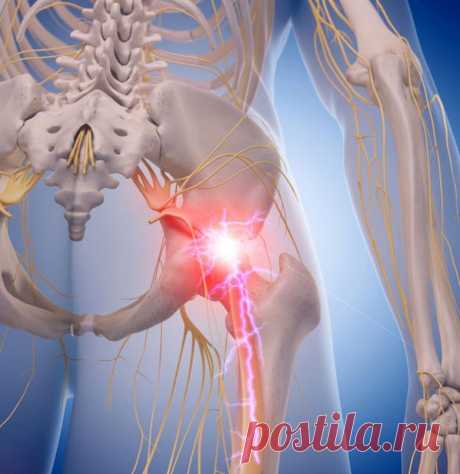 Как снять боль при защемлении седалищного нерва / Будьте здоровы