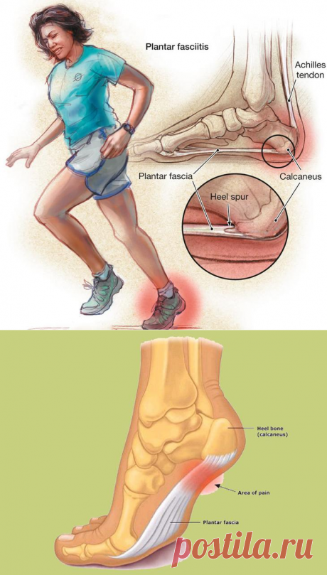 Пяточная шпора: Что делать?