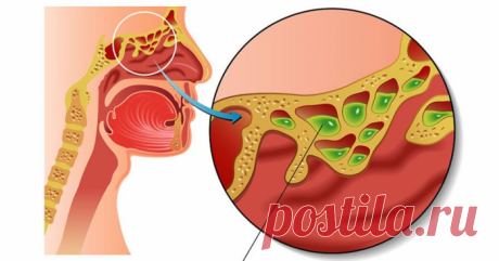 Как вылечить инфекцию пазухи просто и быстро: проверенный рецепт из 4 ингредиентов