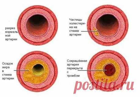 Норма холестерина. Повышенный холестерин и что с ним делать