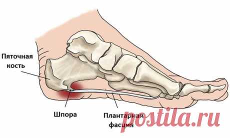 ПЯТОЧНАЯ ШПОРА- ЛЕЧЕНИЕ

Штука неприятная и болезненная. Косметологи утверждают, что шпора - это пожизненное приобретение, и никакое лечение не избавит вас от этой проблемы раз и навсегда. Приобретите в аптеке ортопедические стельки, поднимающие свод стопы и разгружающие пятку. Лечить шпоры можно в домашних условиях проверенными методами.
Показать полностью…