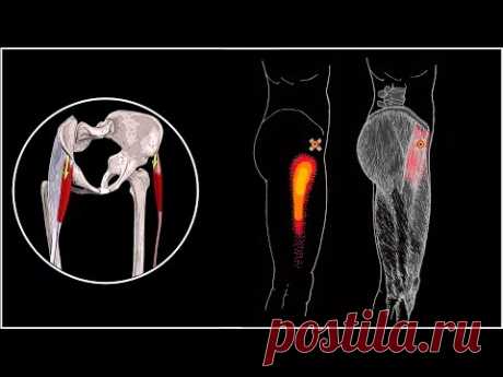 БОЛИТ БОКОВАЯ ПОВЕРХНОСТЬ БЕДРА И ТАЗОБЕДРЕННЫЙ СУСТАВ 🔴 НАПРЯГАТЕЛЬ ШИРОКОЙ ФАСЦИИ БЕДРА