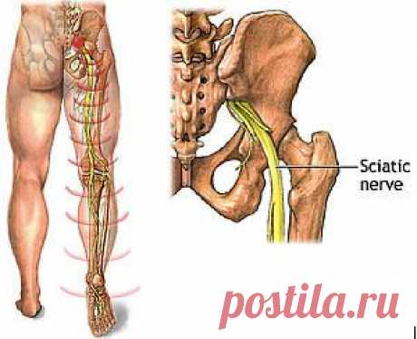 Народные методы лечения невралгии седальщного нерва).