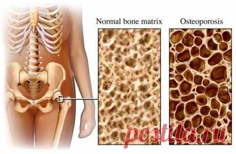Остеопороз - что это такое?