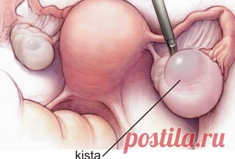 Я только ПИЛА этот напиток и моя киста исчезла за 5 дней! Смотрите самые эффективные рецепты! Этому заболеванию подвержены тысячи женщин со всего мира! Народные рецепты помогают успешно избавиться от него!   Большинство пациентов — молодые женщины и женщи�…