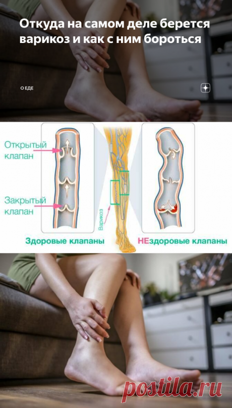 Откуда на самом деле берется варикоз и как с ним бороться
Я уже не молоденькая и с недавних пор на пенсии. Сколько я работала - всегда на ногах, была очень подвижная, а как ушла на пенсию - образ жизни поменялся. И я стала замечать признаки варикоза у себя на ногах.

Вообще я знала, что это когда-то случится, ведь это очень распространённое заболевание, которое встречается у большинства людей. Но всё же я очень огорчилась, когда увидела эти непривлекательные выступающие 
новогоднее меню