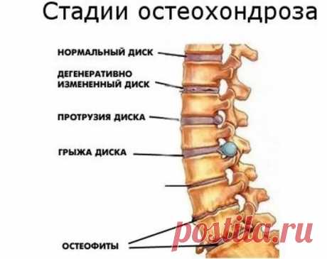 Протрузии позвоночника: упражнения, которые может сделать каждый