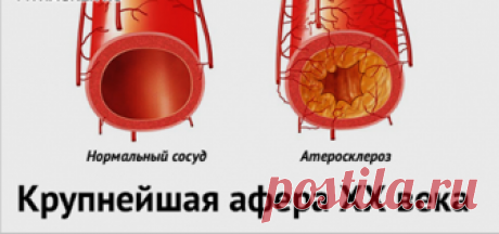 Наука. Kрупнейшая афера XX века Раскрыты главные причины атеросклероза.