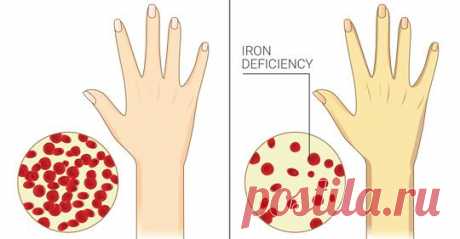 5 признаков хронического дефицита железа. Большинство женщин игнорируют это Железо играет важную роль в организме. Оно помогает в продукции гемоглобина, или протеинов, найденных в клетках крови, которые переносят кислород к различным органам. Дефицит железа ограничивает гемог…