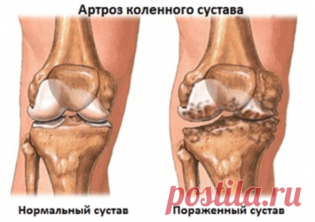 АРТРОЗ КОЛЕННОГО СУСТАВА