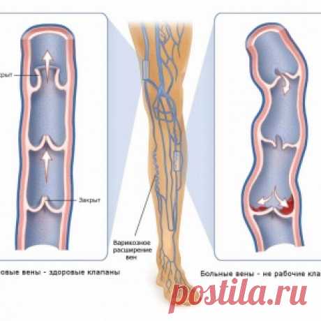 ПОДРОБНО О ВАРИКОЗНОМ РАСШИРЕНИИ ВЕН... - МирТесен