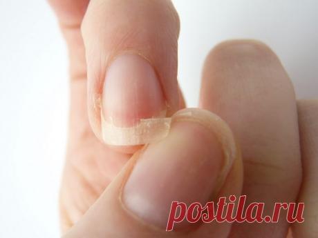 9 точных признаков анемии Как понять, в норме ли уровень гемоглобина, если ты не любитель профилактических походов к врачу?
Ломкие ногти
Если у тебя недостаток железа в организме, даже самый дорогой и изысканный маникюр не пом…