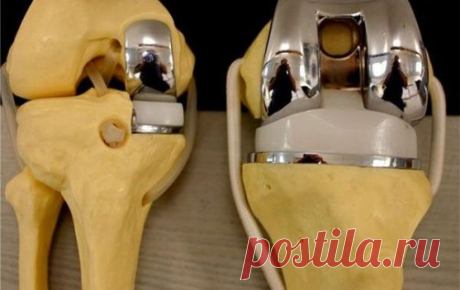 Эндопротезирование коленного сустава – это полная замена разрушенных суставных компонентов искусственными, биологически совместимыми с организмом.