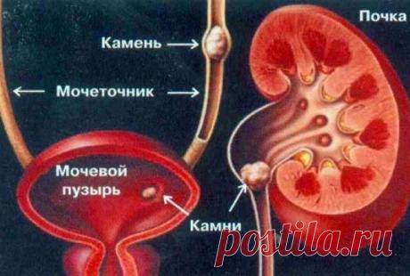 Камни мочевого пузыря. Симптомы, диагностика и лечение камней мочевого пузыря.