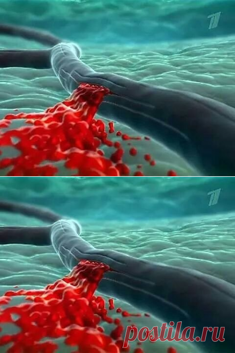 помощь при инсульте