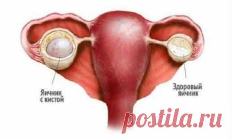 Какие признаки свидетельствуют о наличии патологии яичника Киста яичника – самая распространённая гинекологическая патология, новообразование может иметь разный характер, поэтому симптомы кист отличаются.