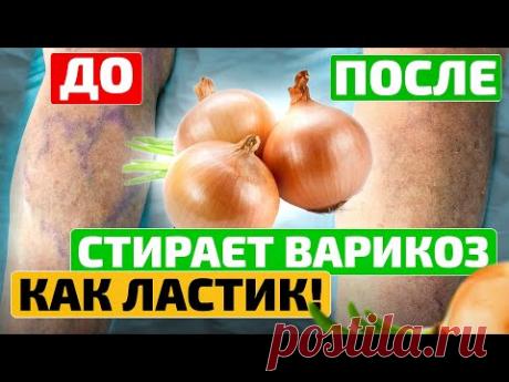 Я не ожидала ТАКОГО, когда нанесла луковое масло и... Как избавиться от варикоза и тромбов
