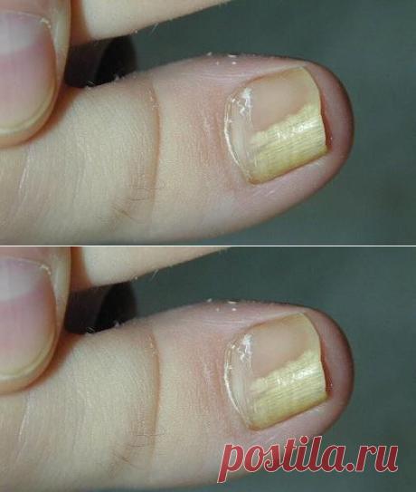 ГРИБОК ногтя