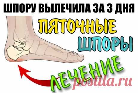 ШПОРУ ВЫЛЕЧИЛА ЗА 3 ДНЯ Поделюсь рецептами от пяточных шпор. Прошлым летом на юге после ванн у меня так разболелась нога, что я не знала, куда ее деть. Пятка горела огнем.