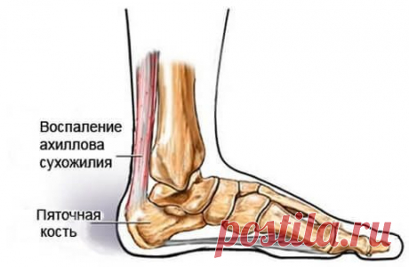Выполняйте эти упражнения при воспалении ахиллова сухожилия / Будьте здоровы