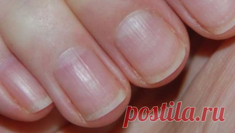 Если на ваших ногтях есть вертикальные борозды - значит, у вас серьезные проблемы! | От здоровья к красоте | Яндекс Дзен