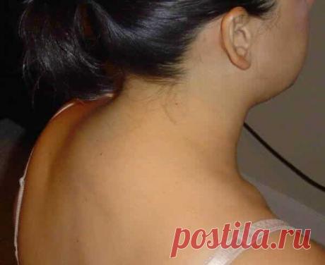 14 способов удаления шишки на шее (отложения солей)