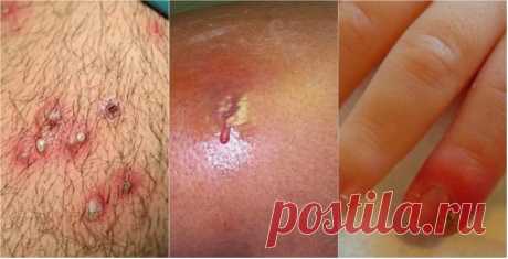 Что нужно знать о золотистом стафилококке? / Будьте здоровы