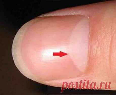 Знаете ли вы, что действительно означает полумесяц на вашем ногте? Ответ более важен, чем вы думаете Важная информация! Вы заметили белое пятно в форме полумесяца на основании ногтей? Это называется лунула, то есть, маленькая луна, и это очень важно для здоровья ваших ногтей. Глядя на вашу лунулу, вы также можете хорошо следить за здоровьем остального тела. Как растет ваш ноготь. Под кожей, покрывающей основу ваших ногтей, есть корень или матрица. Этот корень — это то, гд...