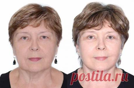 Кокосовое масло для лица: применение, польза, отзывы, как использовать от морщин, прыщей, для кожи вокруг глаз, рецепты масок, противопоказания