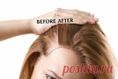 Секретная формула для магической терапии потери волос Эта маска работает безотказно!